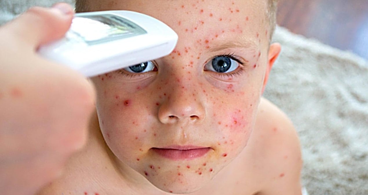 Aşılanmamış her 10 çocuktan 9’u kızamık oluyor